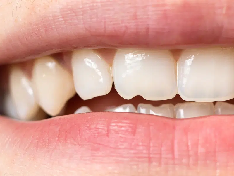 chipped tooth in Shelby Township MI