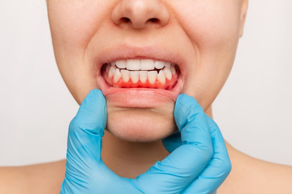 doctor pulling down a patients lower lip exposing inflamed gums