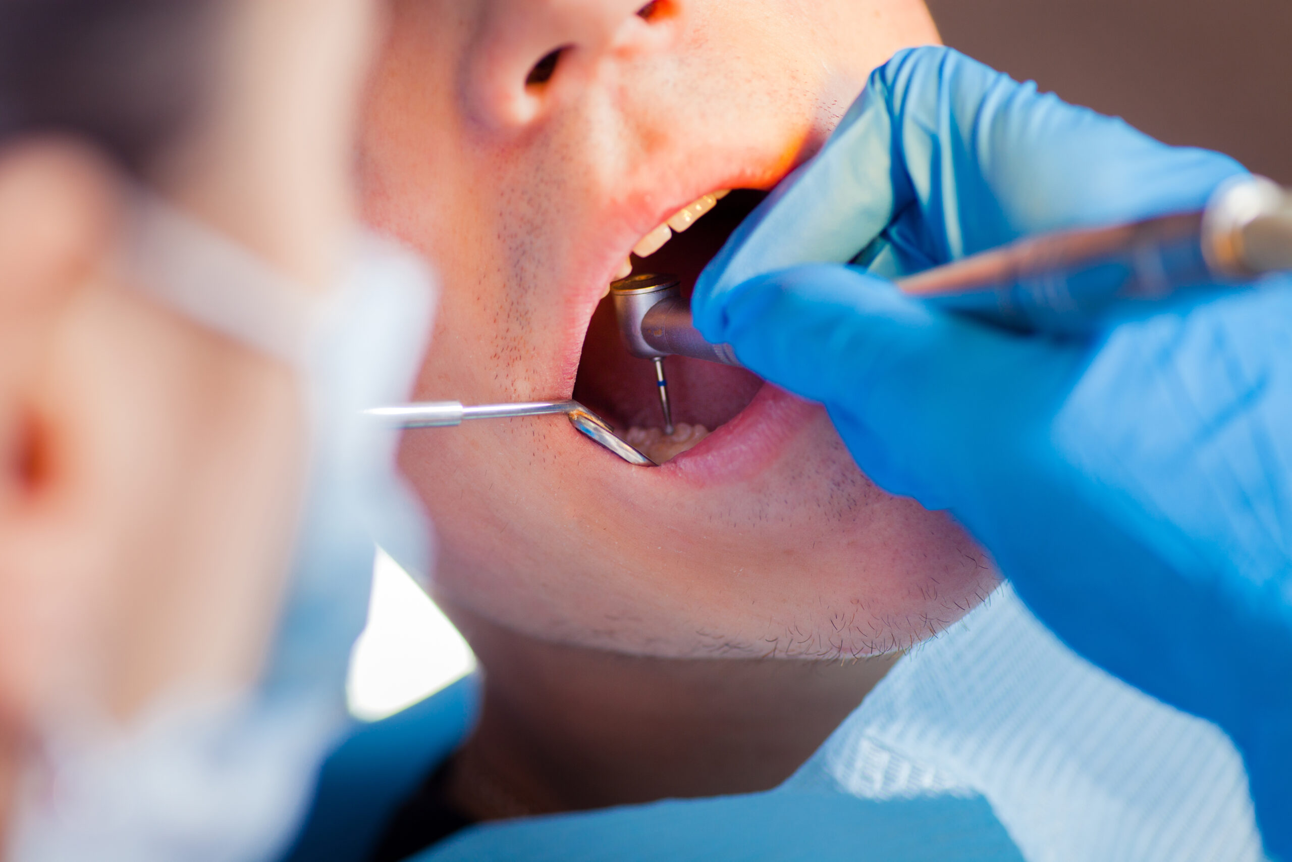 doctor examining a tooth that needs extraction