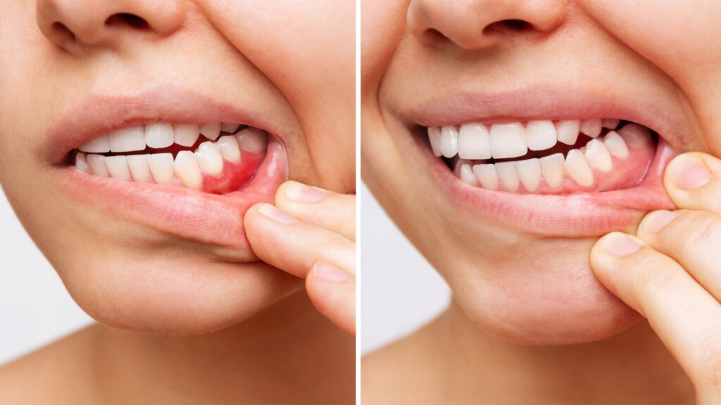 side by side of gum disease progression