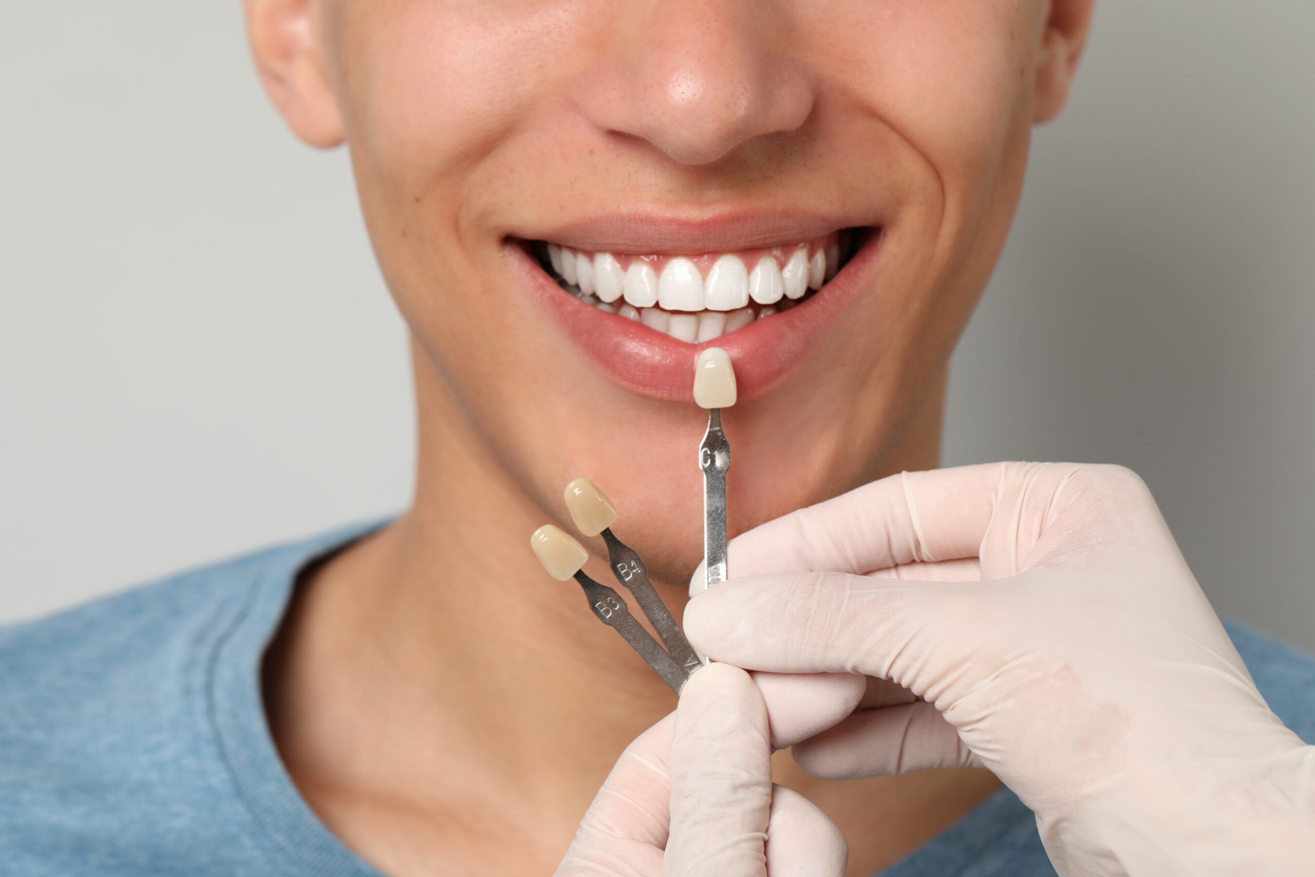 dentist in gloves checking veneer shades against a mans smile